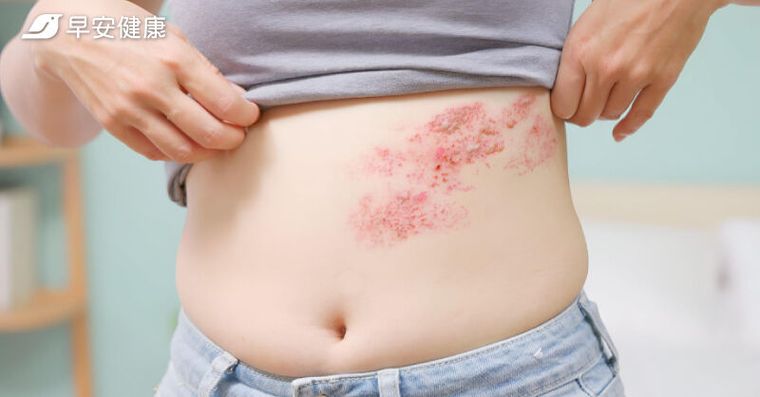 皮蛇原因有哪些？瞭解帶狀疱疹與中風雙向關聯性